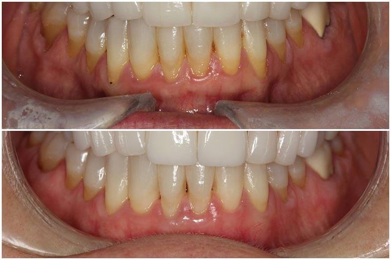 Gum surgery treatment at Dr. Madhuri Bhandari Dental Clinic in Pimpri Chinchwad Pune