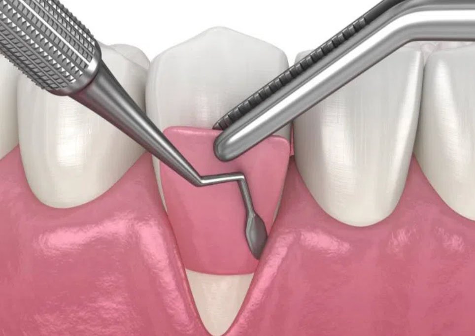Gum surgery treatment at Dr. Madhuri Bhandari Dental Clinic in Pimpri Chinchwad Pune