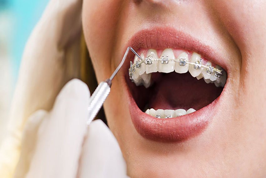 Orthodontic treatment with dental braces at Dr. Madhuri Bhandari Dental Clinic in Pimpri Chinchwad Pune