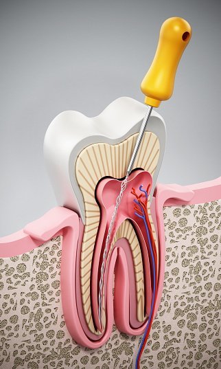 dentist performing root canal treatment in Pimpri Chinchwad Pune