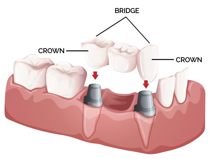 Dental crowns and bridges treatment at Dr. Madhuri Bhandari Dental Clinic in Pimpri Chinchwad Pune