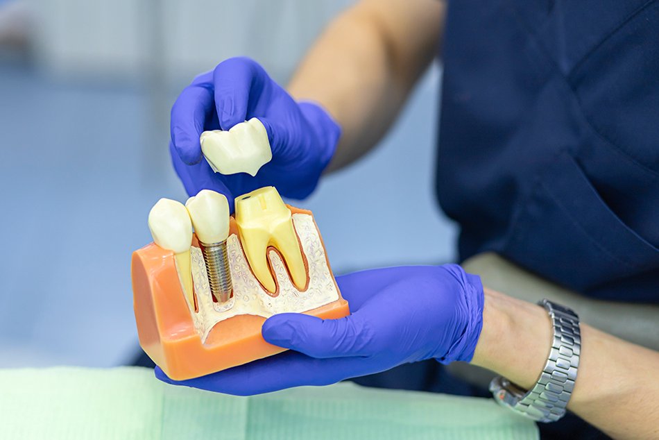 Dental crowns and bridges treatment at Dr. Madhuri Bhandari Dental Clinic in Pimpri Chinchwad Pune