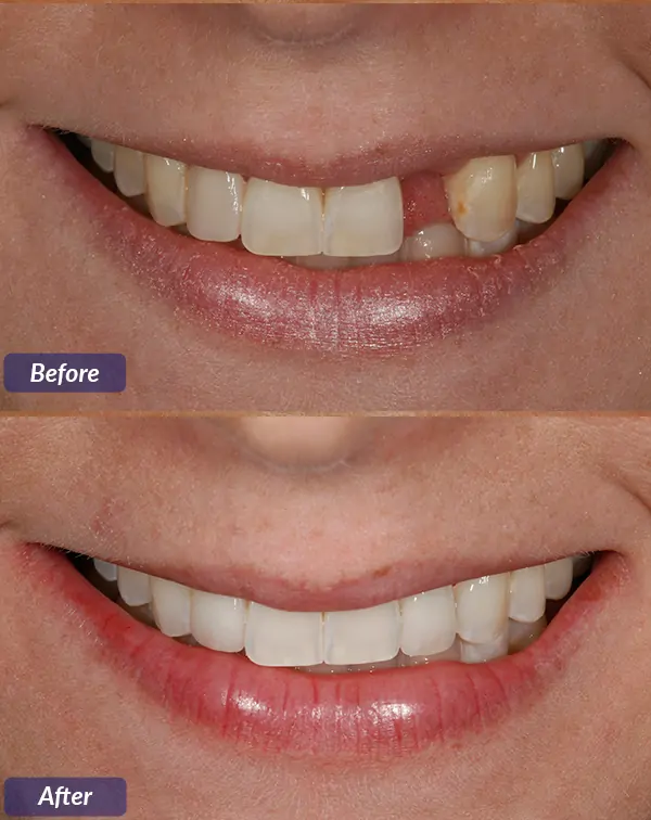 Dental implant treatment at Dr. Madhuri Bhandari Dental Clinic in Pimpri Chinchwad Pune