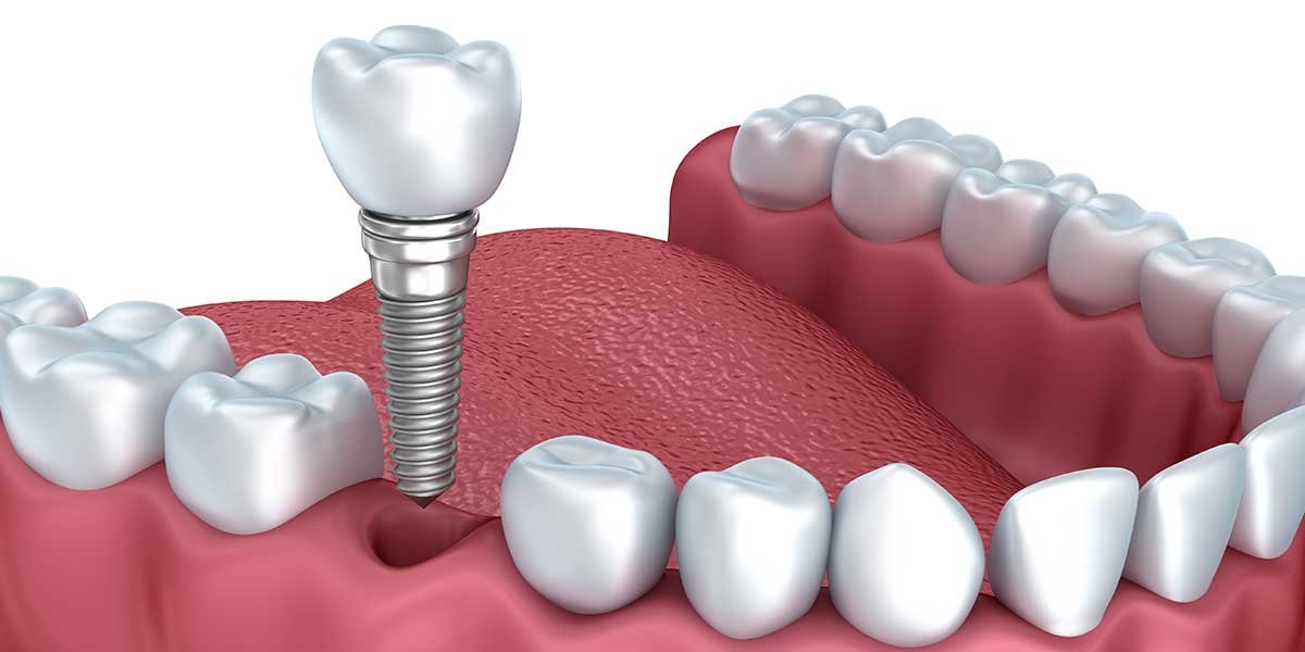 Dental implant treatment at Dr. Madhuri Bhandari Dental Clinic in Pimpri Chinchwad Pune