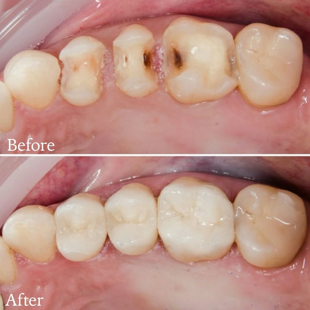 Dental filling treatment at Dr. Madhuri Bhandari Dental Clinic in Pimpri Chinchwad Pune