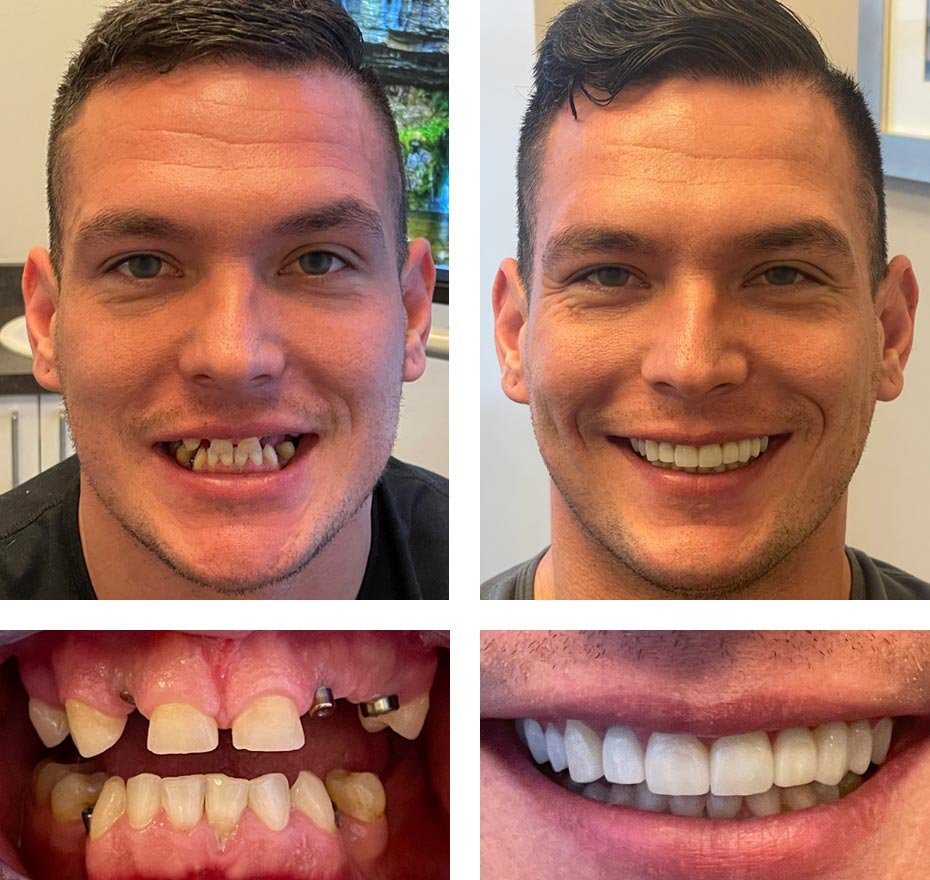 Implantologist service at Dr. Madhuri Bhandari Dental Clinic in Pimpri Chinchwad Pune