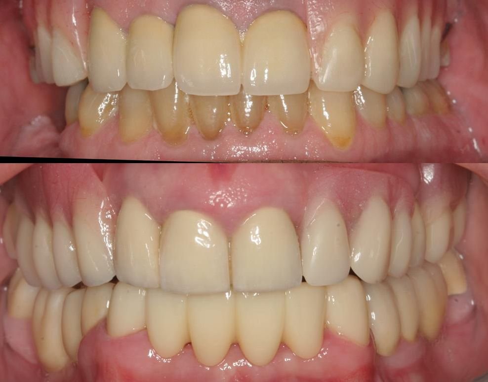 Precision attachment denture treatment at Dr. Madhuri Bhandari Dental Clinic in Pimpri Chinchwad Pune