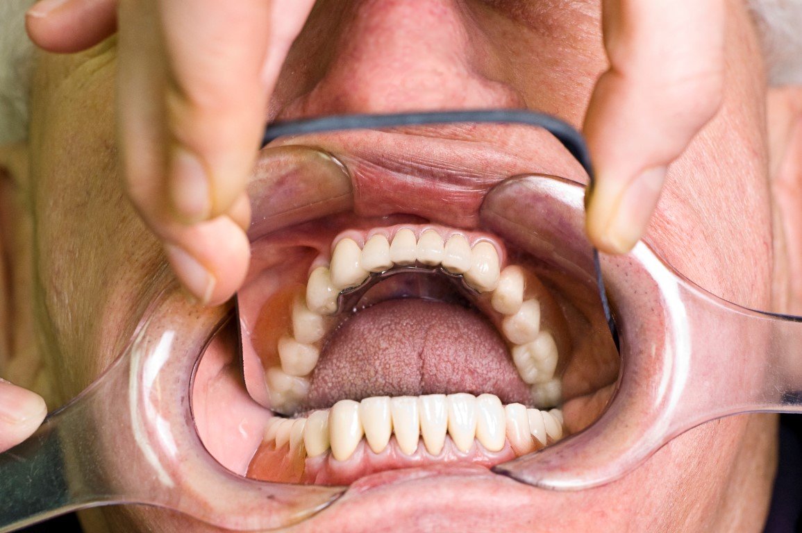 precision attachment dentures treatment in Pimpri Chinchwad Pune
