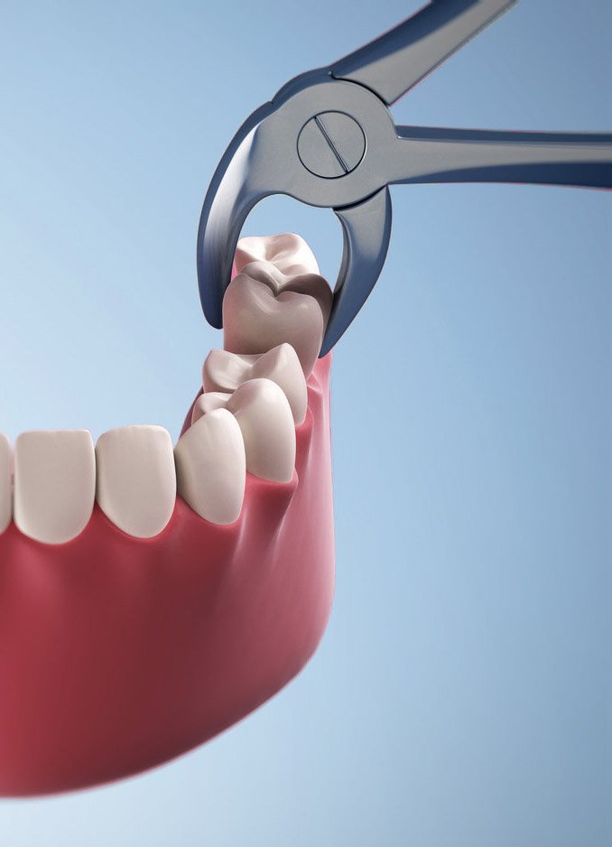 Wisdom tooth removal treatment at Dr. Madhuri Bhandari Dental Clinic in Pimpri Chinchwad Pune