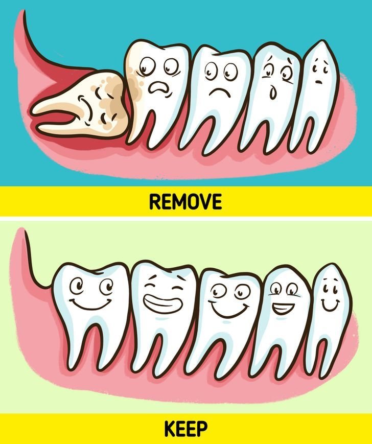 Wisdom tooth removal treatment at Dr. Madhuri Bhandari Dental Clinic in Pimpri Chinchwad Pune