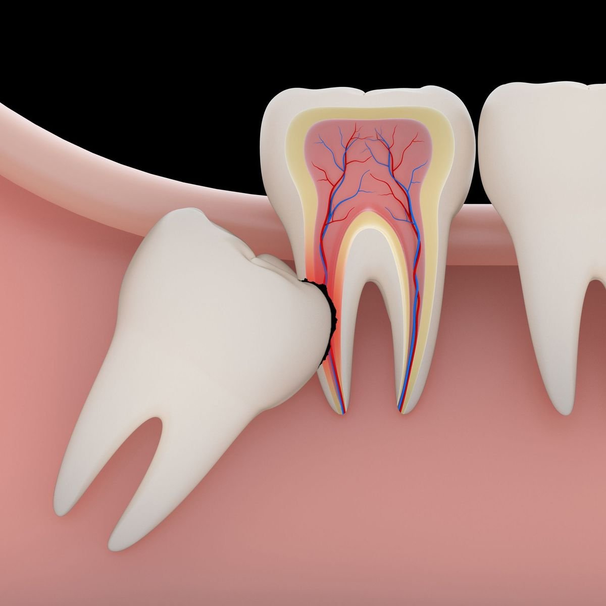 Wisdom tooth removal treatment at Dr. Madhuri Bhandari Dental Clinic in Pimpri Chinchwad Pune